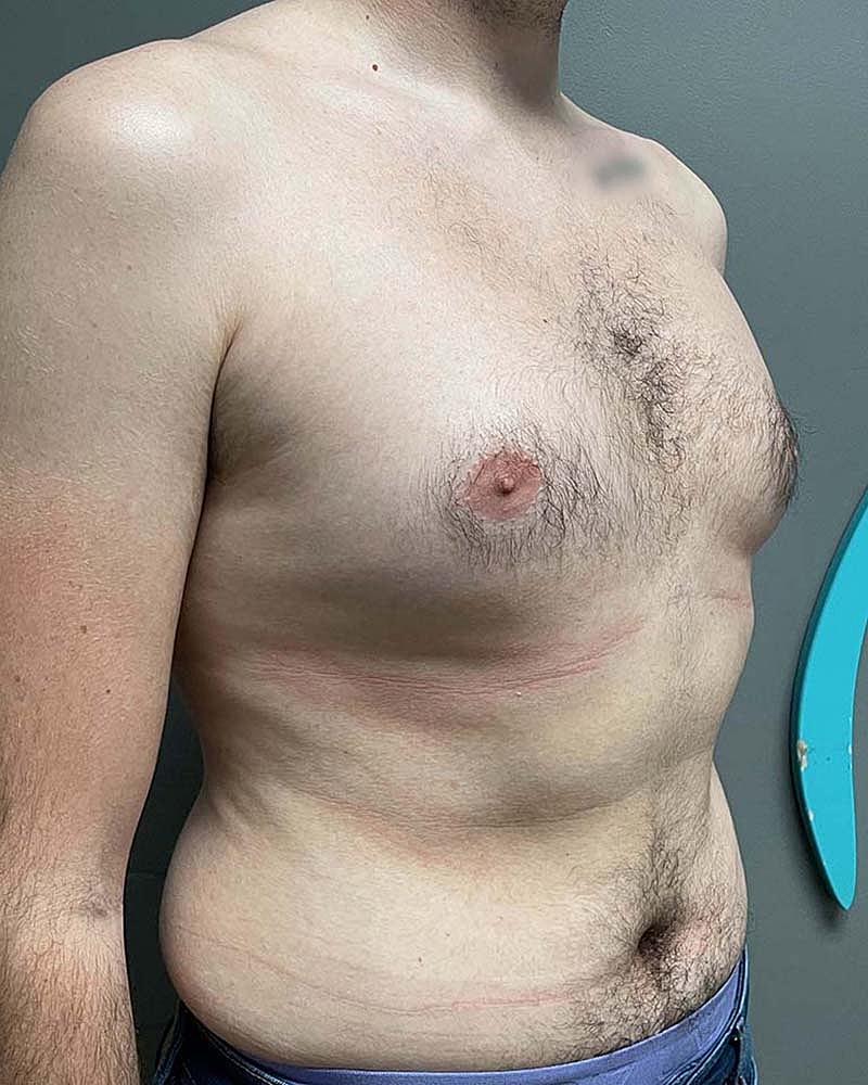 Gynecomastectomy Before & After