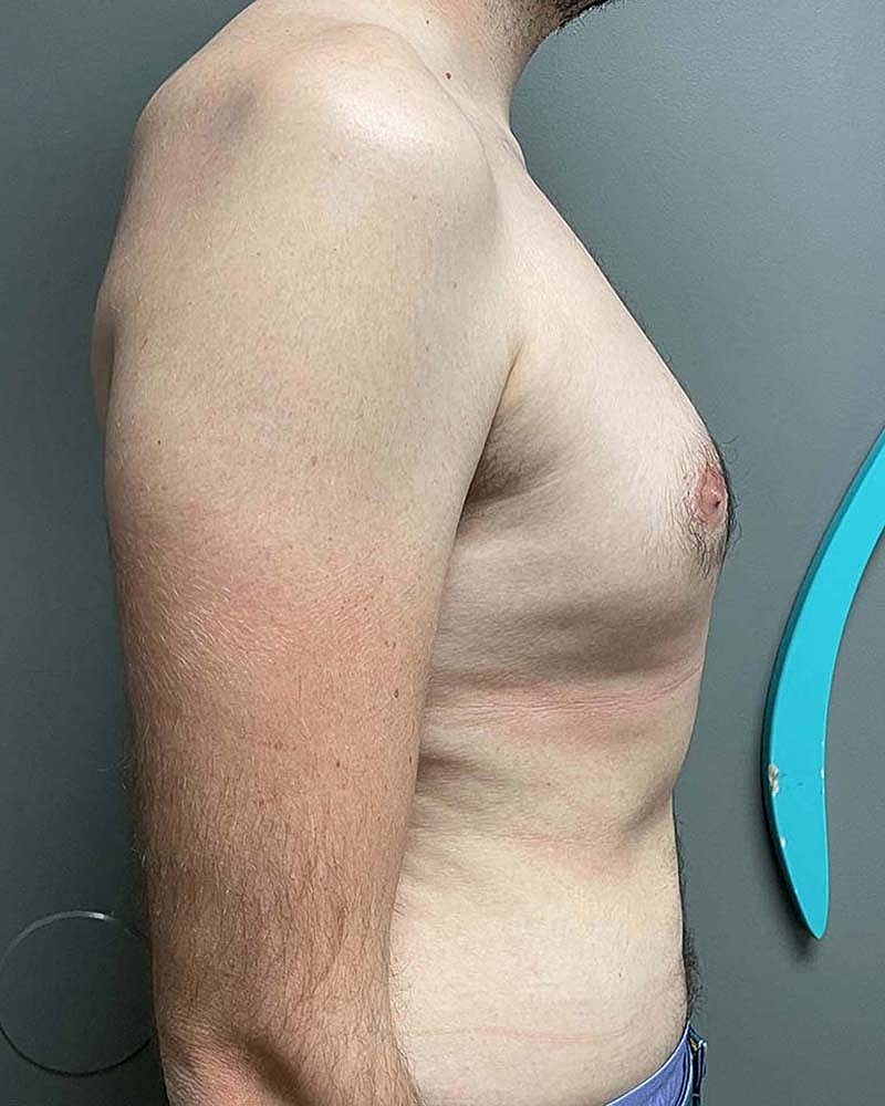 Gynecomastectomy Before & After
