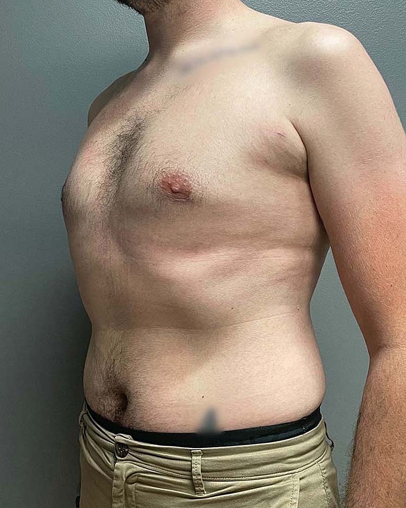 Gynecomastectomy Before & After