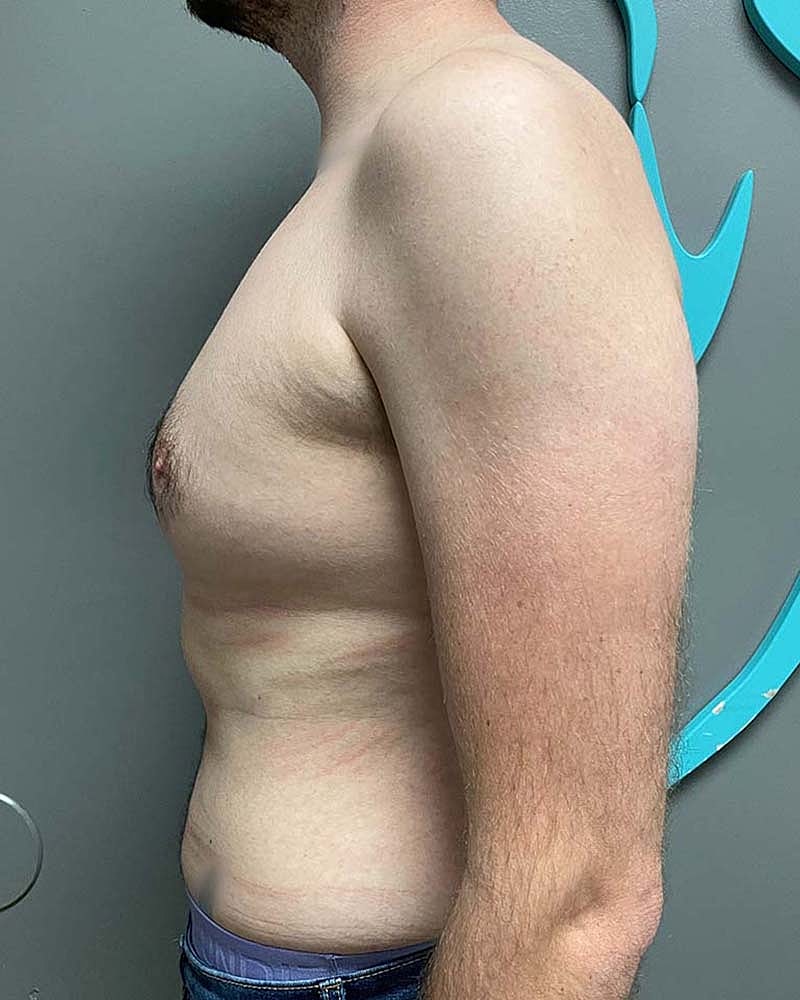 Gynecomastectomy Before & After