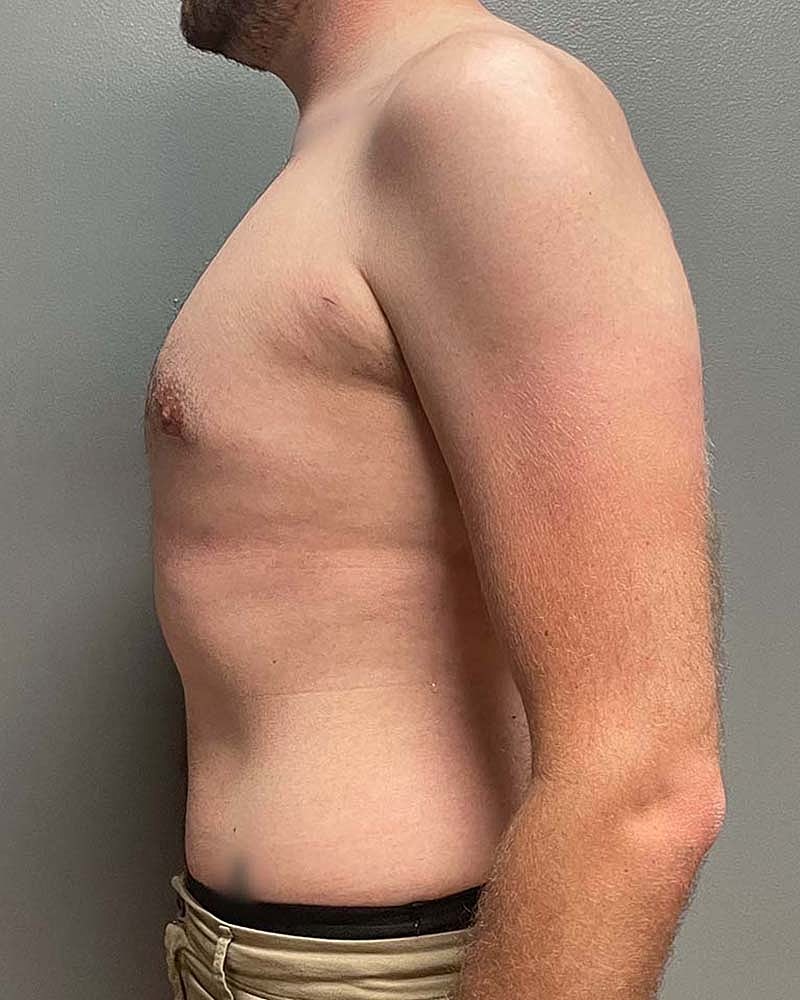 Gynecomastectomy Before & After