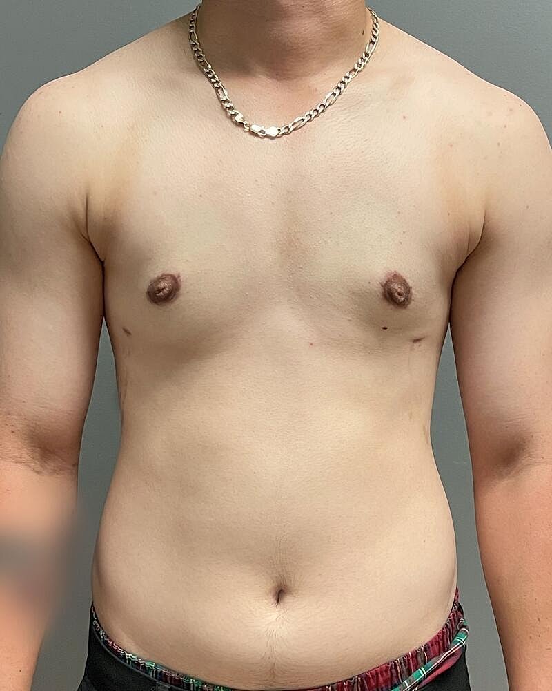 Gynecomastectomy Before & After