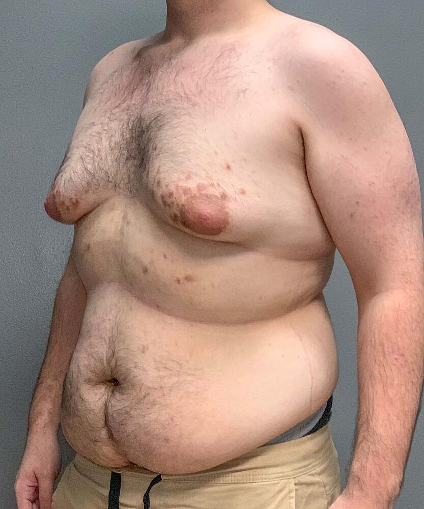 Gynecomastectomy Before & After
