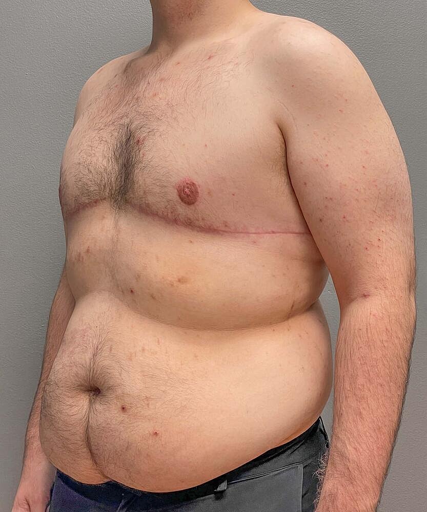 Gynecomastectomy Before & After