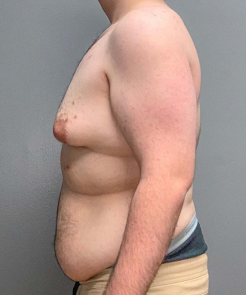 Gynecomastectomy Before & After
