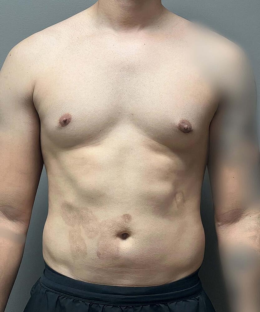 Gynecomastectomy Before & After