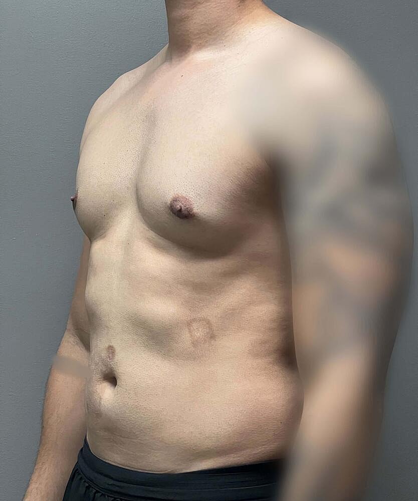 Gynecomastectomy Before & After