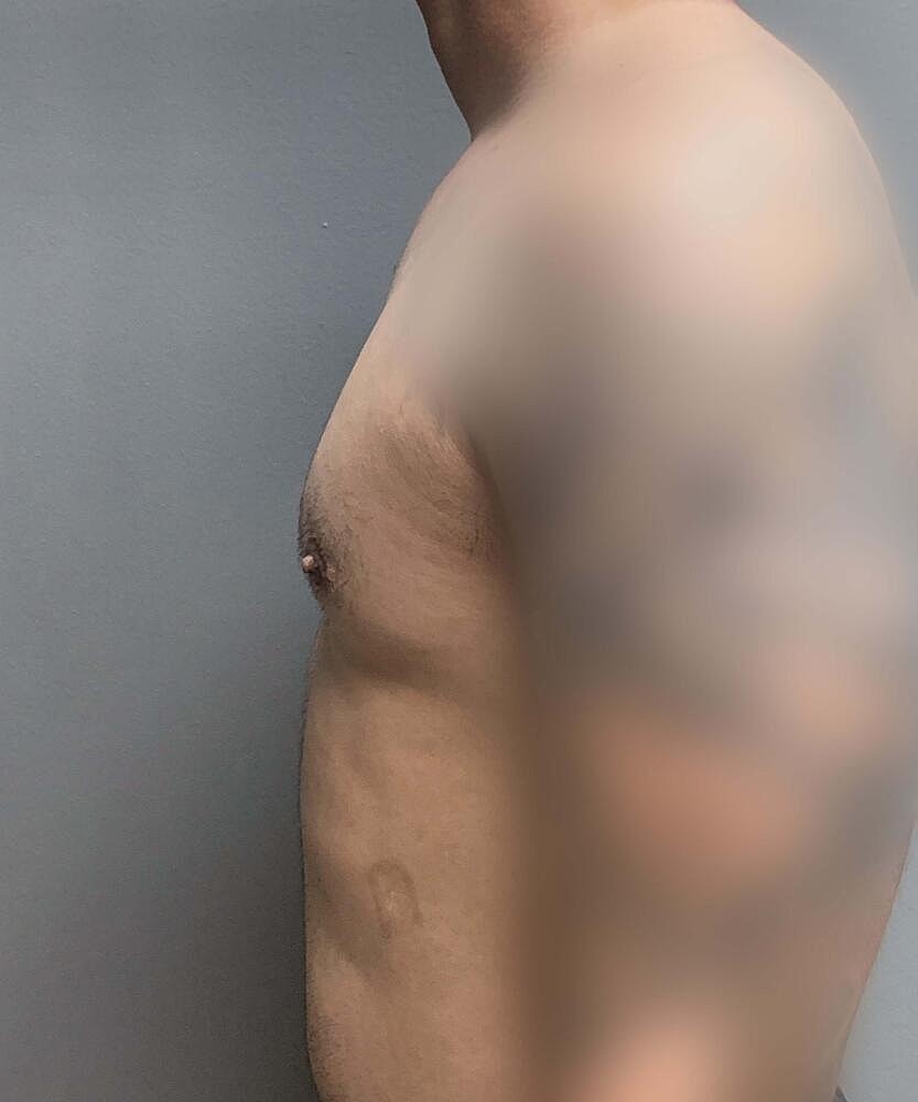 Gynecomastectomy Before & After