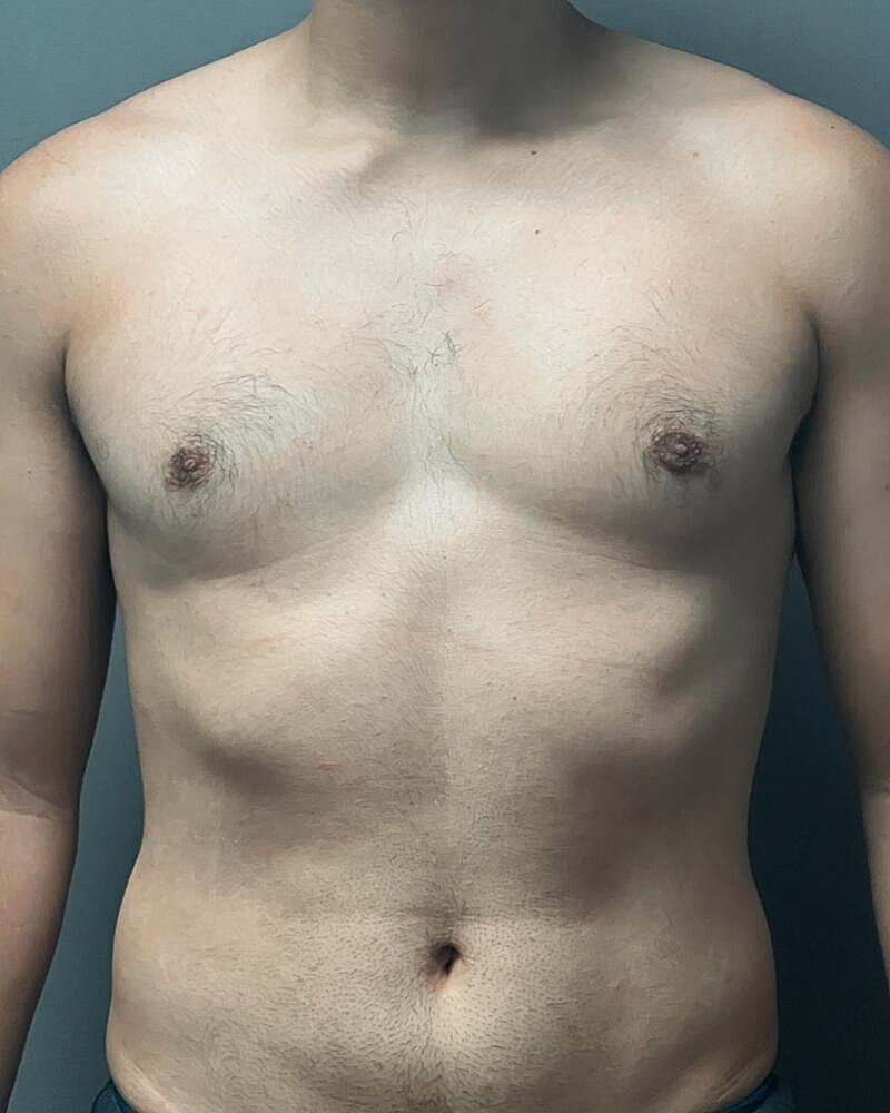 Gynecomastectomy Before & After