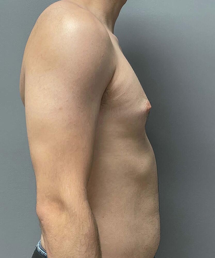 Gynecomastectomy Before & After
