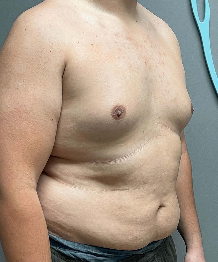 Gynecomastectomy Before & After