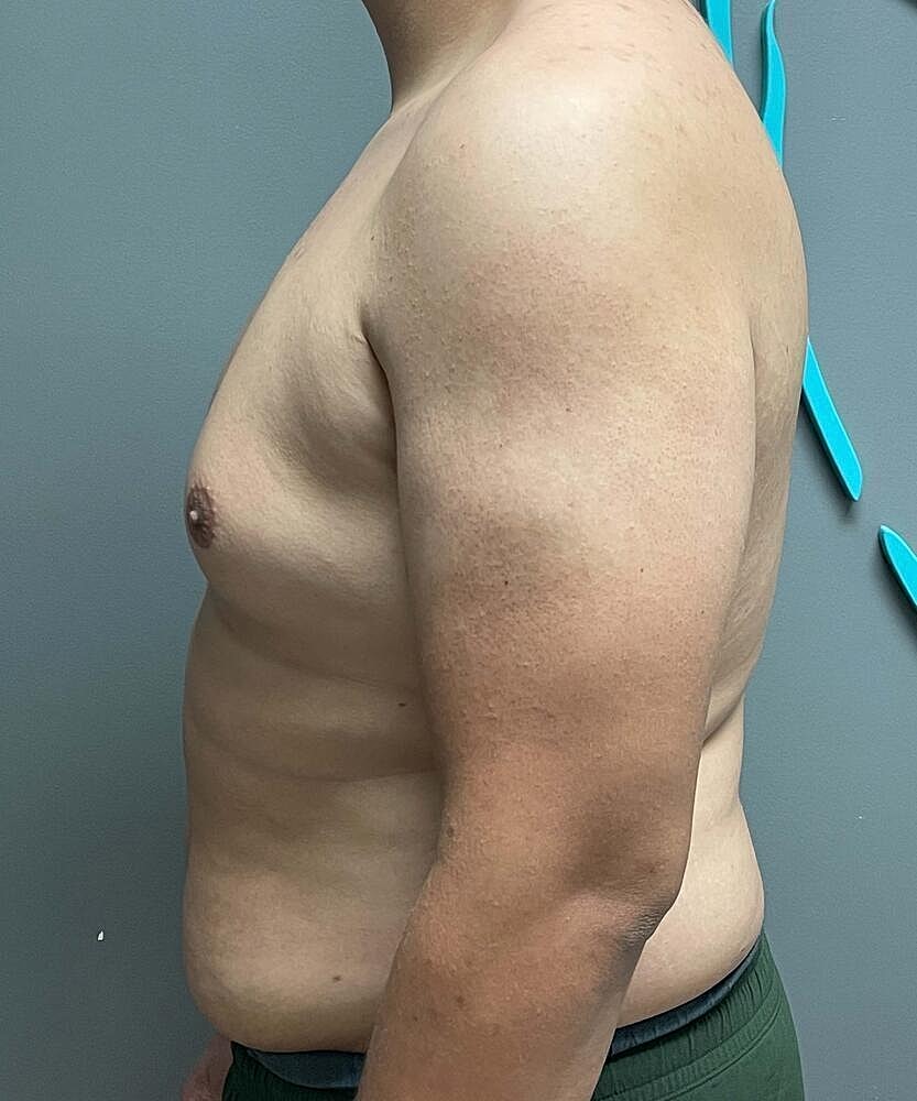Gynecomastectomy Before & After
