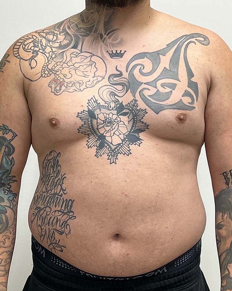 Gynecomastectomy Before & After