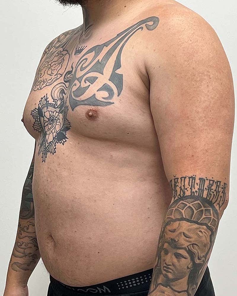 Gynecomastectomy Before & After