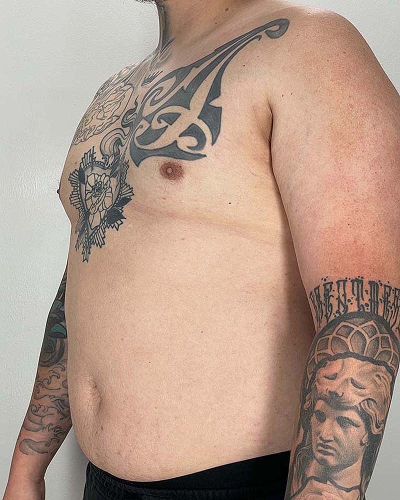 Gynecomastectomy Before & After