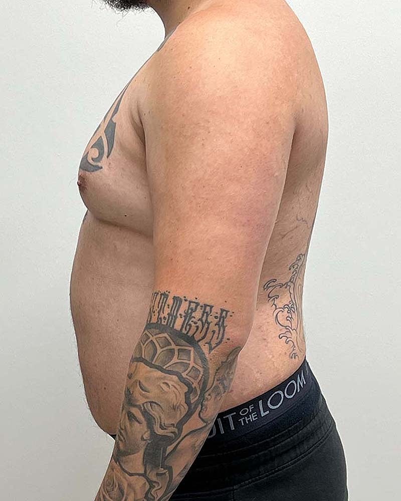 Gynecomastectomy Before & After