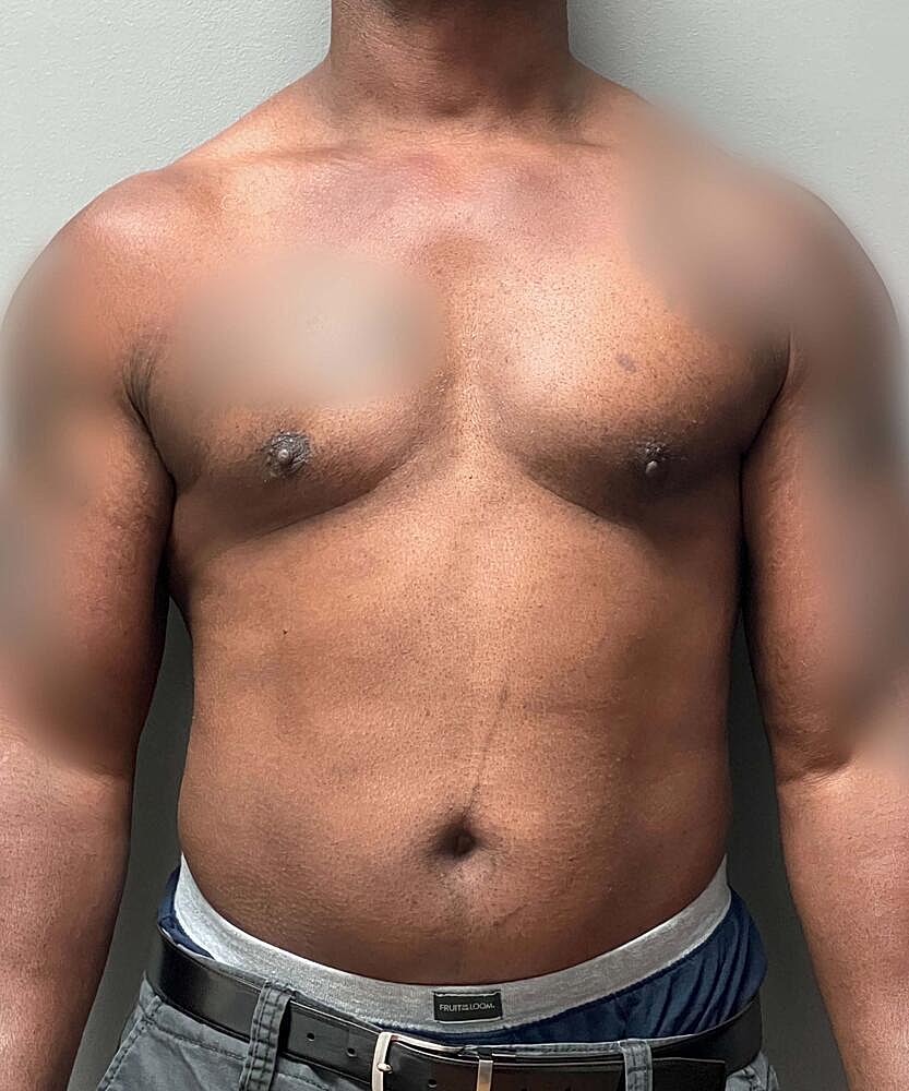 Gynecomastectomy Before & After