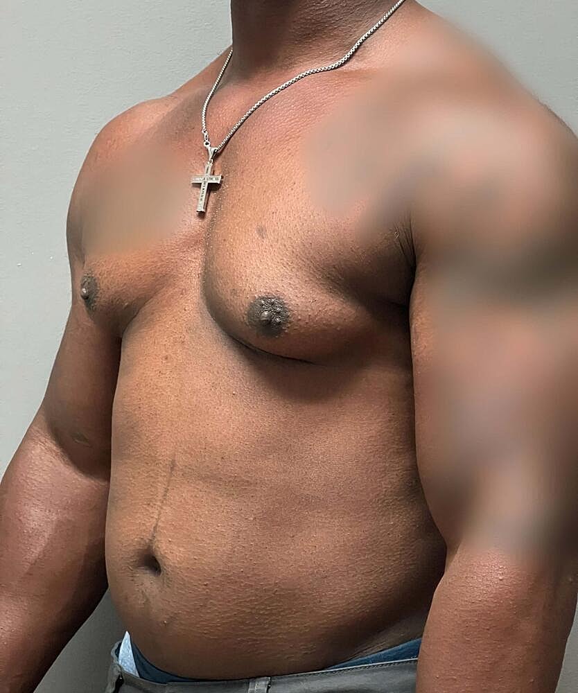 Gynecomastectomy Before & After