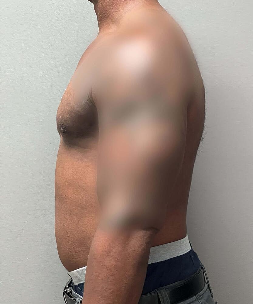 Gynecomastectomy Before & After