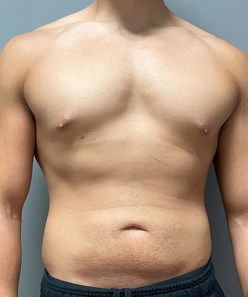 Gynecomastectomy Before & After