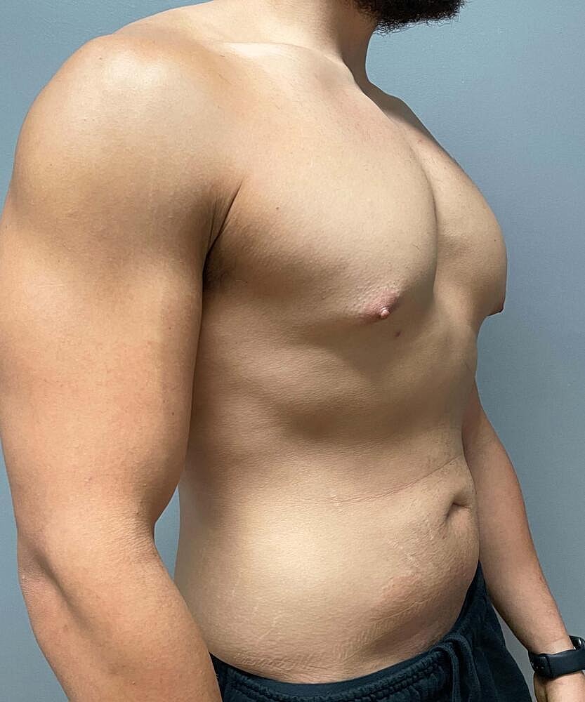 Gynecomastectomy Before & After