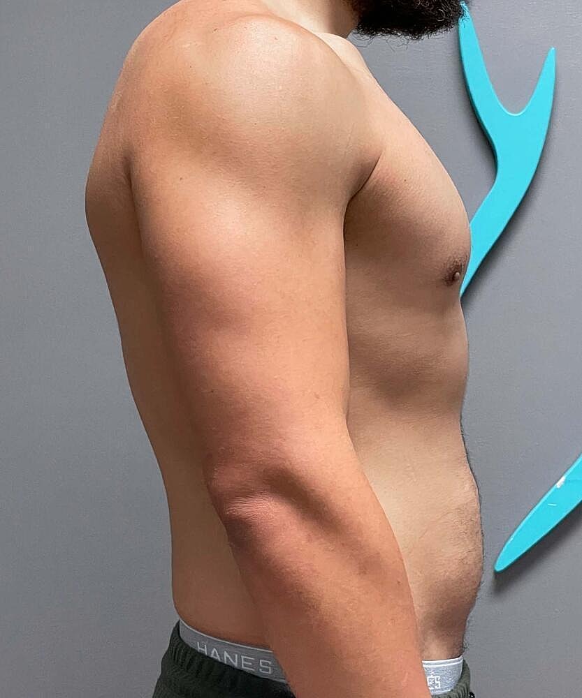 Gynecomastectomy Before & After