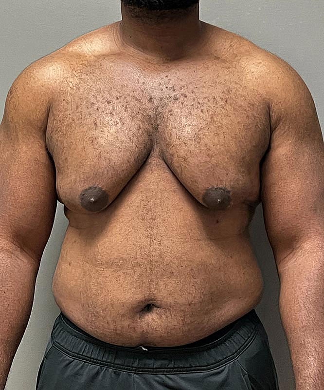 Gynecomastectomy Before & After
