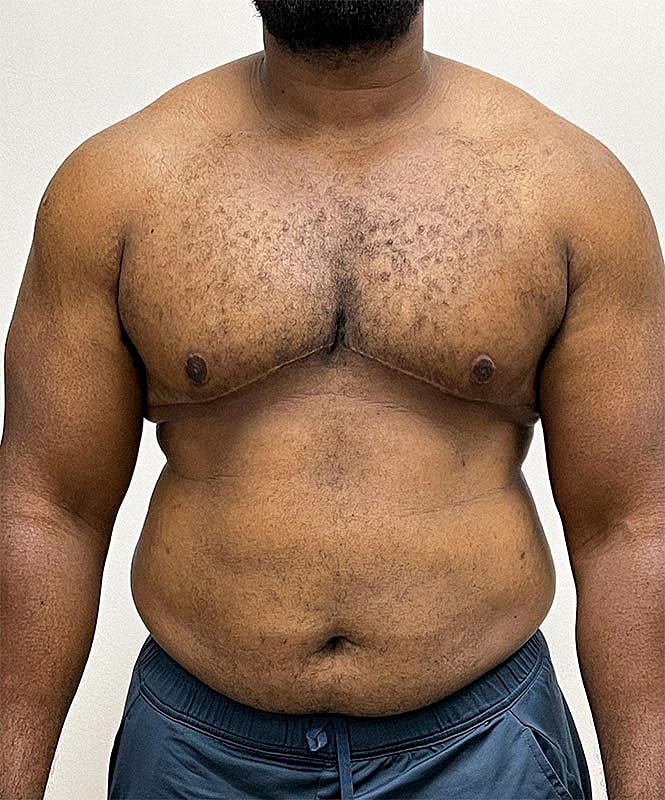 Gynecomastectomy Before & After