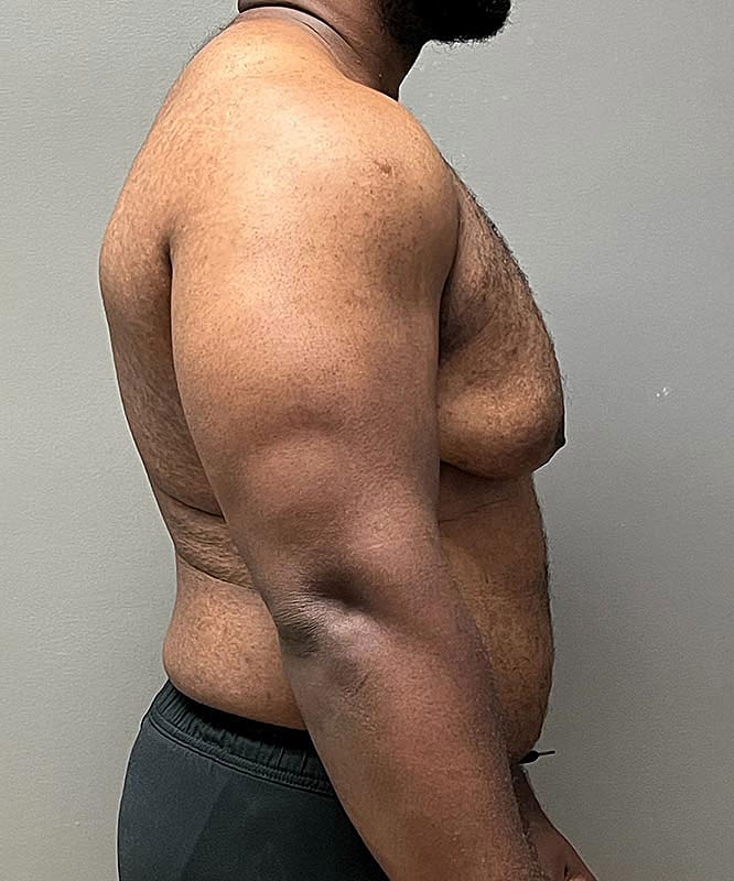 Gynecomastectomy Before & After