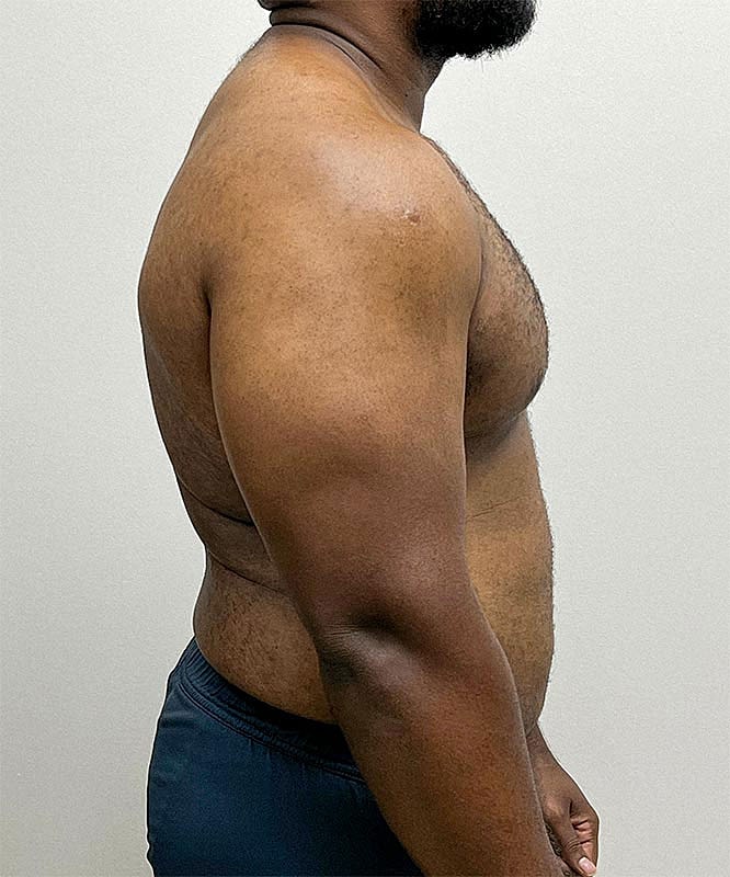 Gynecomastectomy Before & After