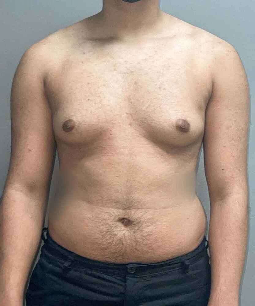 Gynecomastectomy Before & After