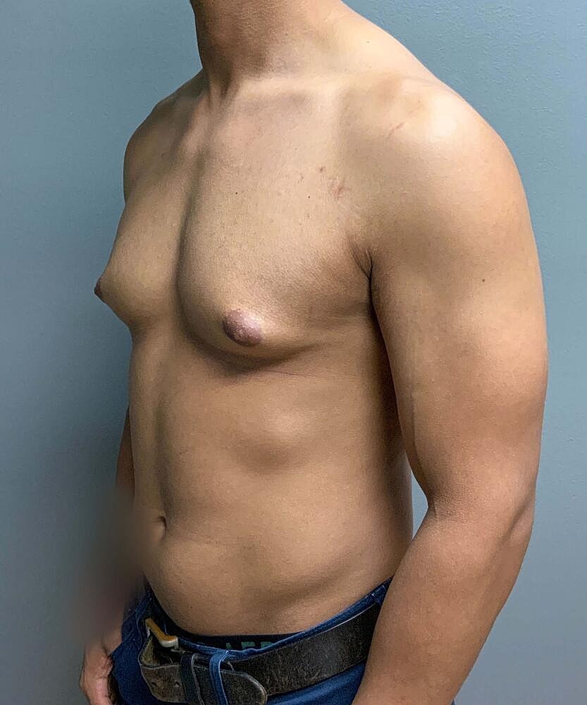Gynecomastectomy Before & After