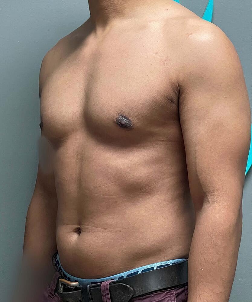 Gynecomastectomy Before & After