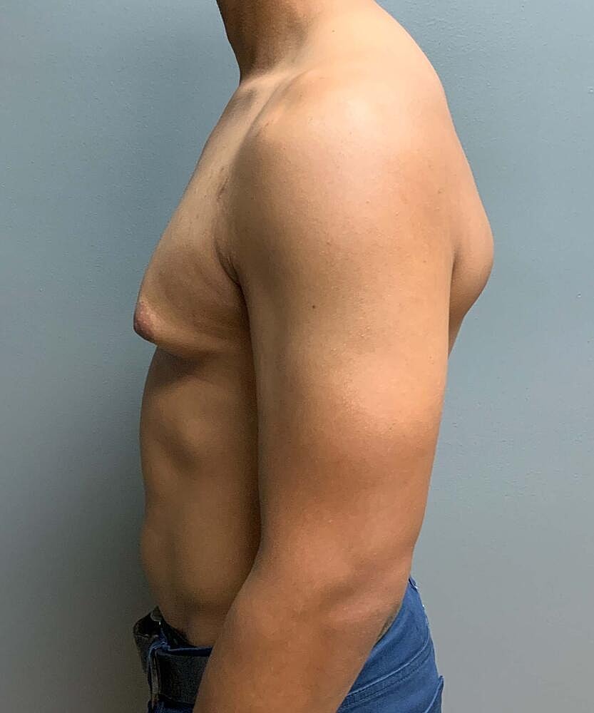 Gynecomastectomy Before & After