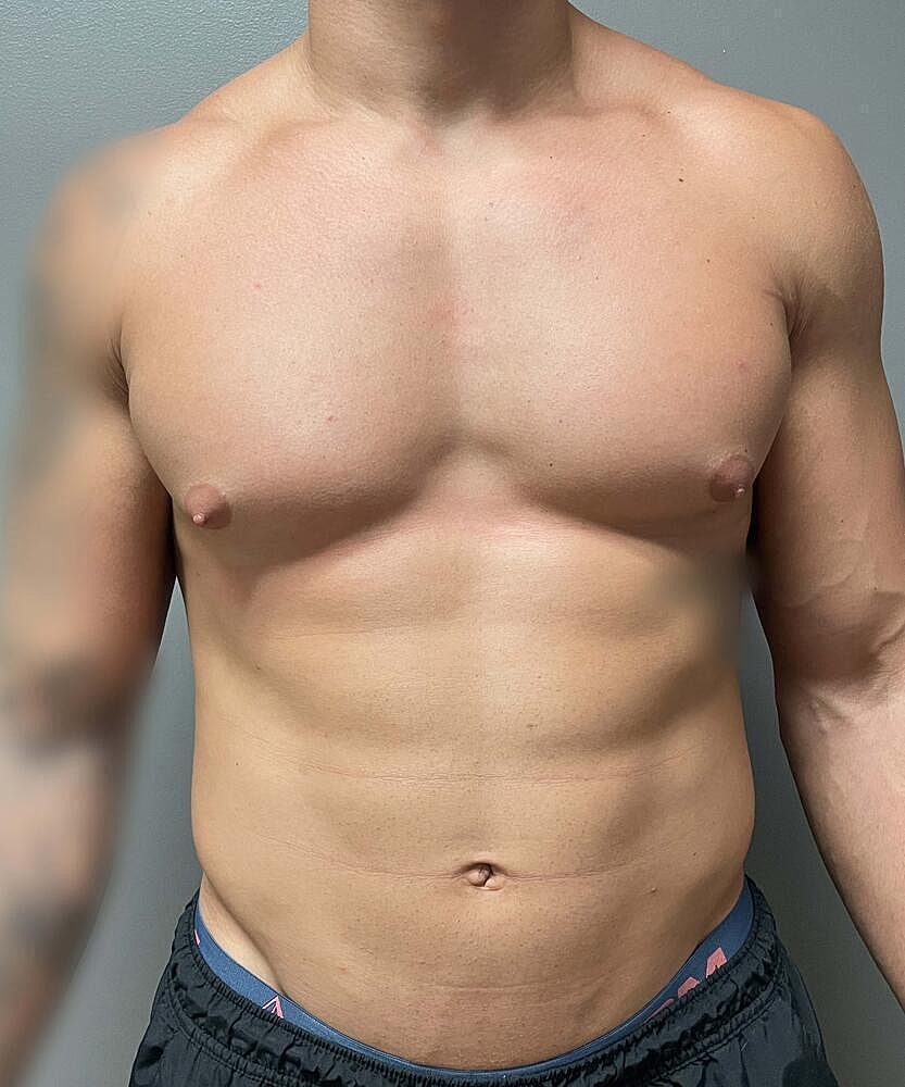 Gynecomastectomy Before & After