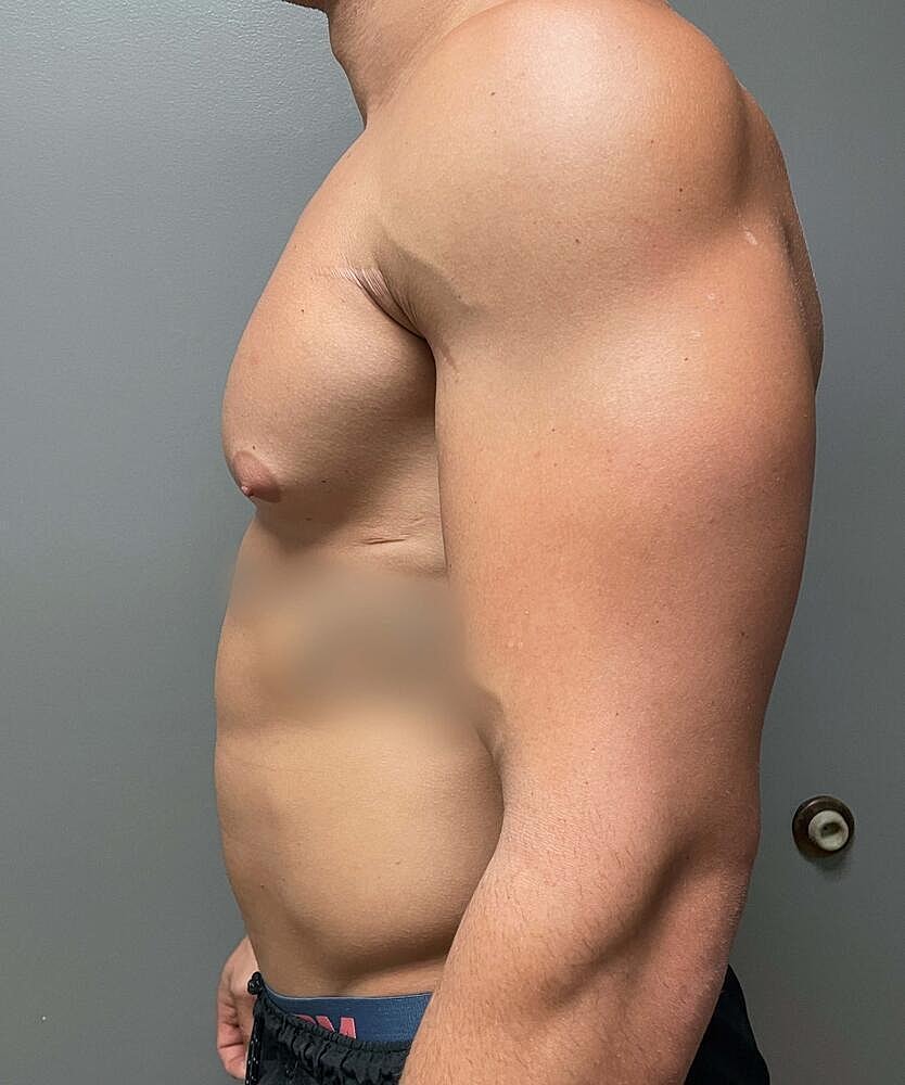 Gynecomastectomy Before & After