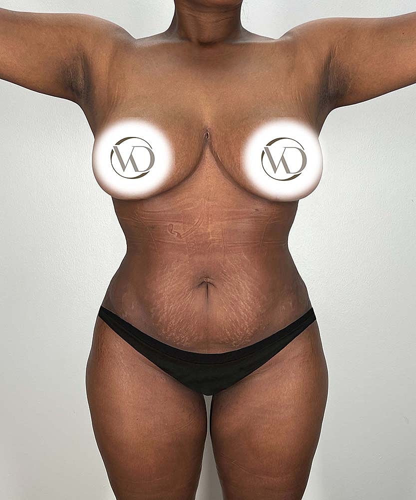 Fat Grafting To Hips Before & After