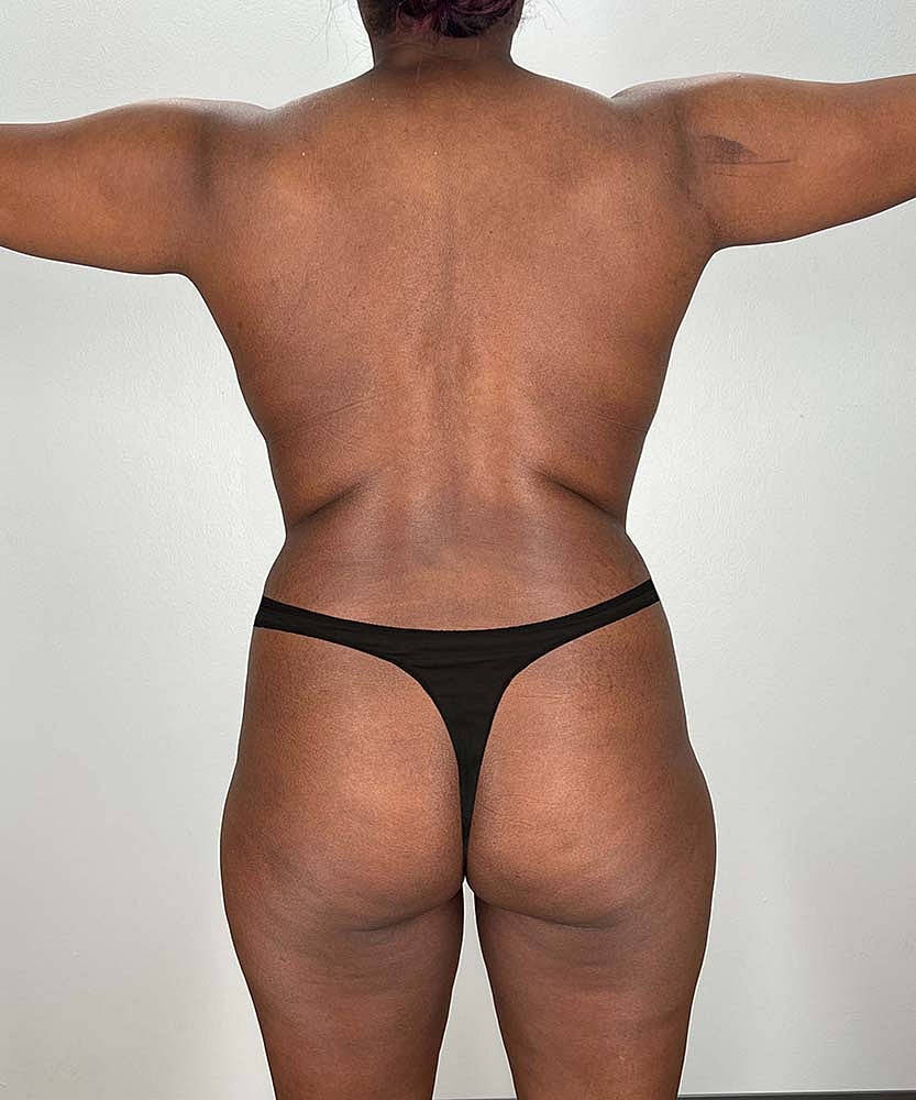 Fat Grafting To Hips Before & After