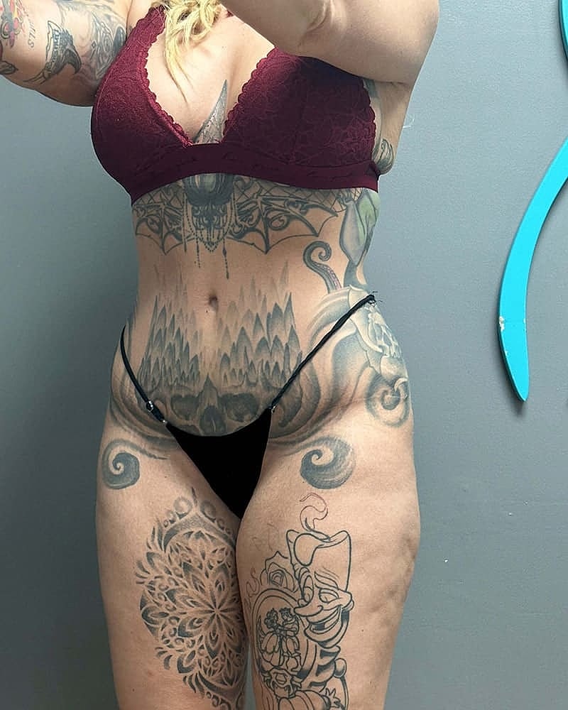 Fat Grafting To Hips Before & After