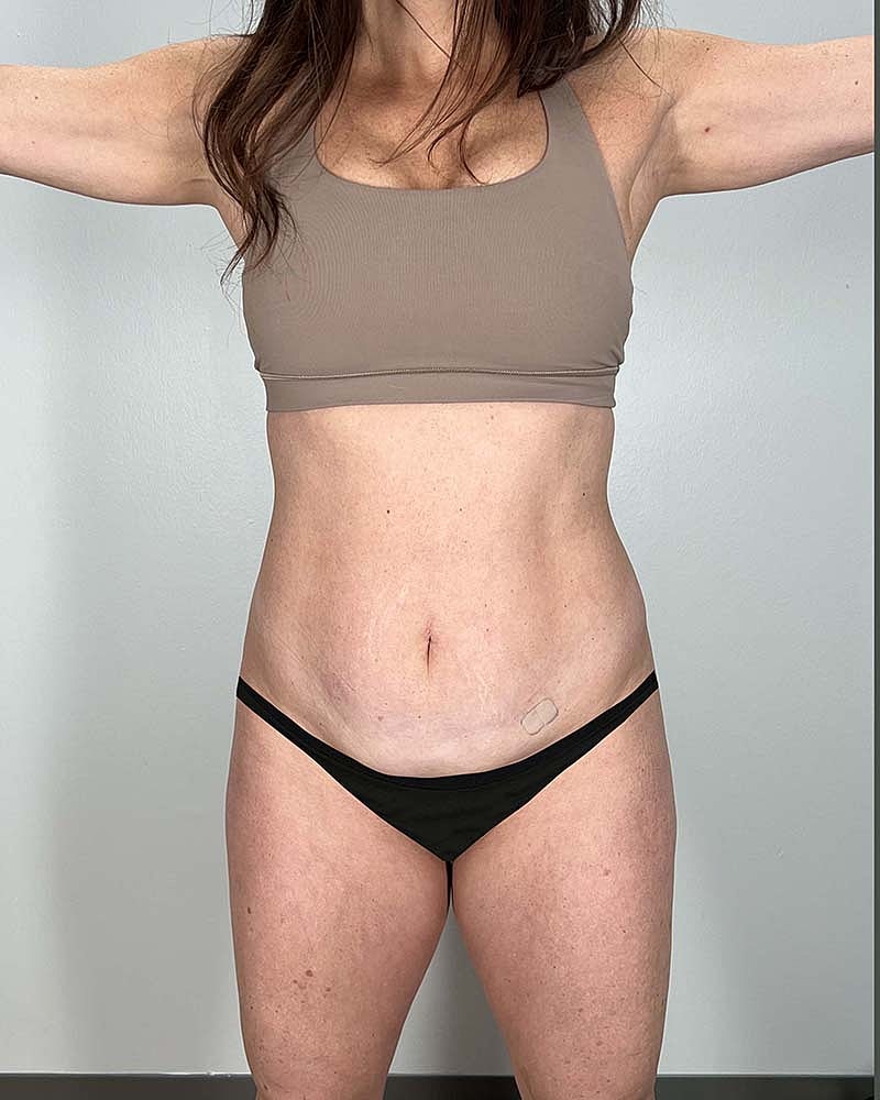 Fat Grafting To Hips Before & After