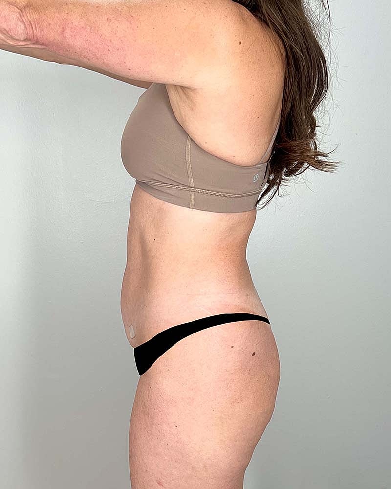 Fat Grafting To Hips Before & After