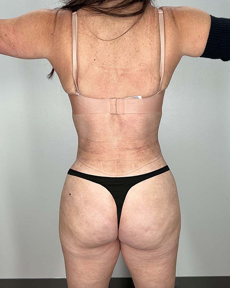 Fat Grafting To Hips Before & After