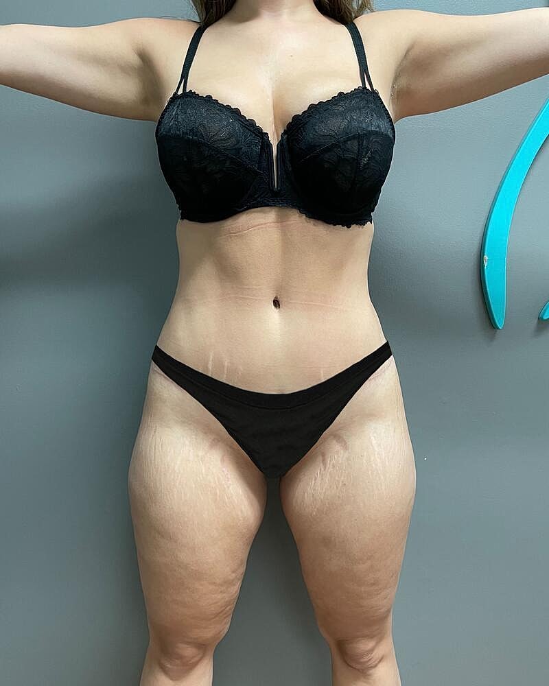 Fat Grafting To Hips Before & After
