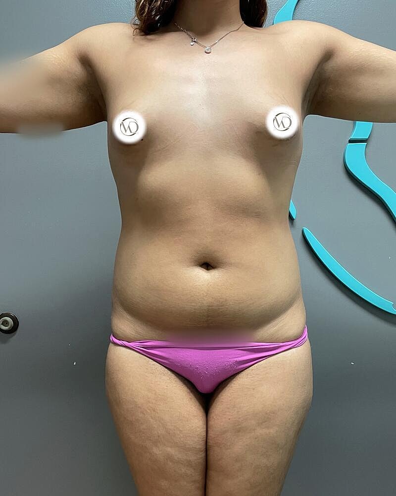 Fat Grafting To Hips Before & After