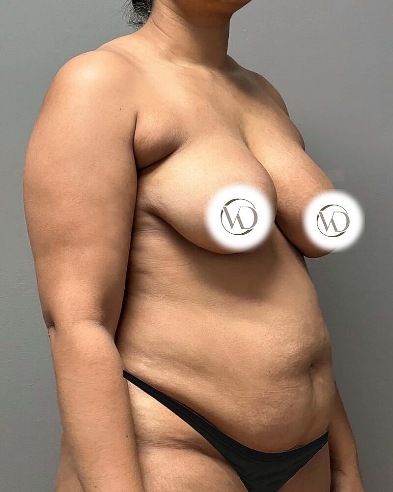 Fat Grafting To Hips Before & After