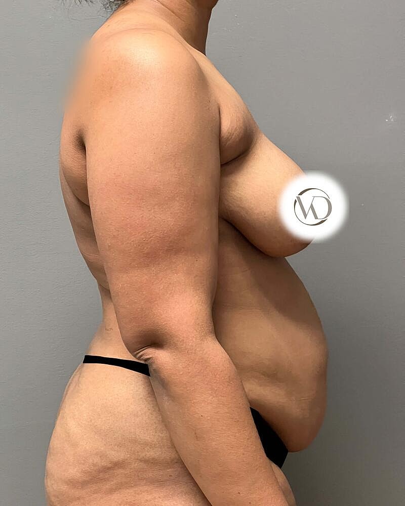 Fat Grafting To Hips Before & After