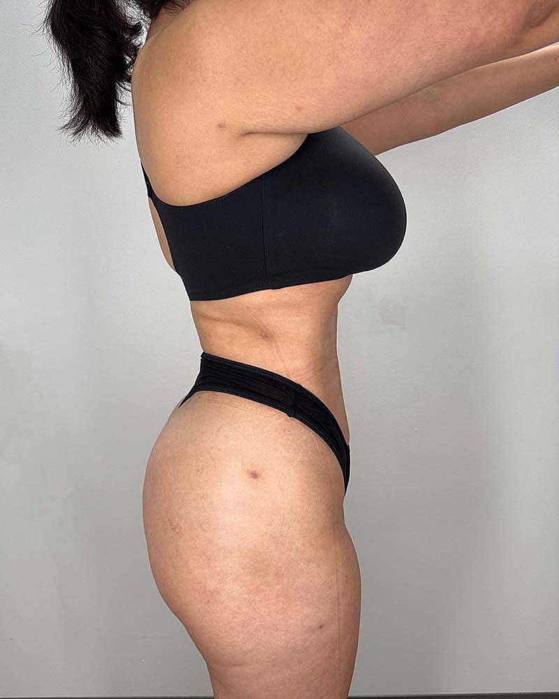 Fat Grafting To Hips Before & After