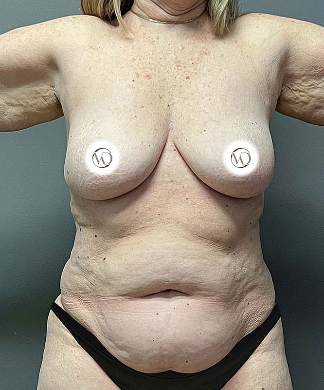 Breast Lift Before & After