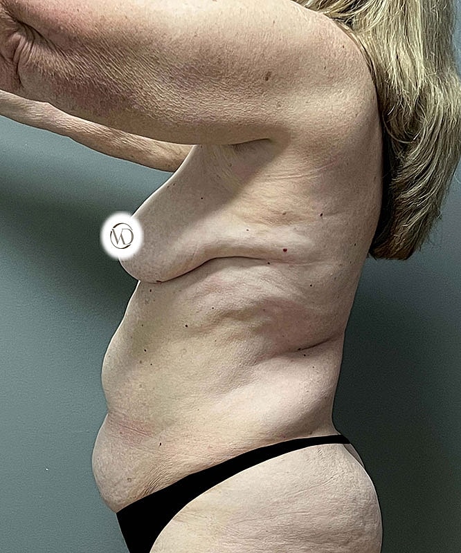 Breast Lift Before & After