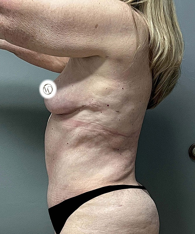 Breast Lift Before & After